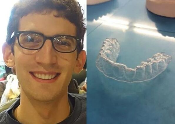 美大学生利用3D技术自制透明牙套 成本60美元