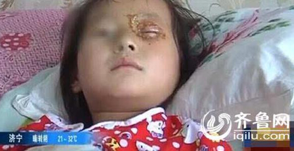 音乐蜡烛突然爆炸 6岁女童角结膜眼睑皮肤被烫伤(图)
