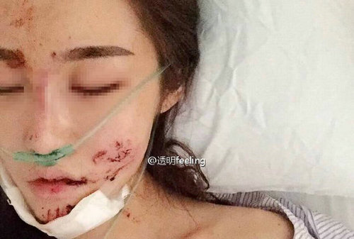 知名网红被毁容 病床憔悴照片曝光
