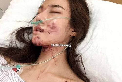 知名网红被毁容 病床憔悴照片曝光