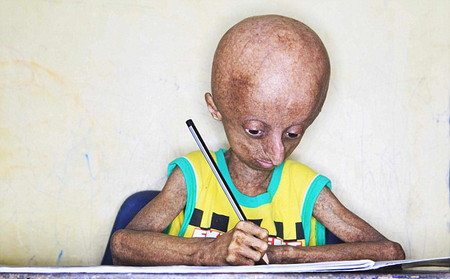 福州夫妻皮肤白净 却生下非洲宝宝(31)-千龙