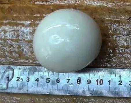 男子腹痛就诊发现“舍利子”：浑圆似玉