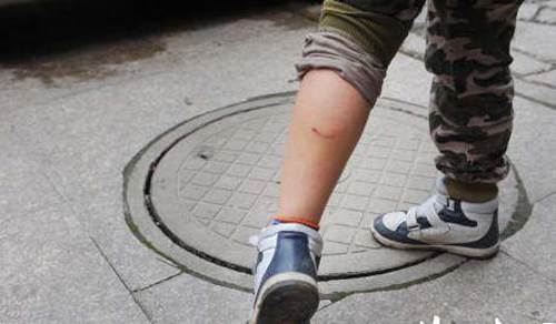 孩子的小腿上留下了一排牙印