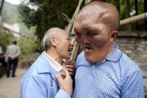 图为患病男子。