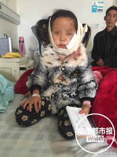 贵州8岁女童惨遭疯狗咬烂半边脸