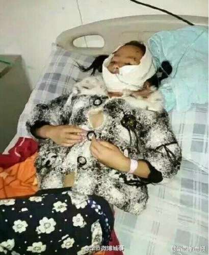 贵州8岁女童惨遭疯狗咬烂半边脸
