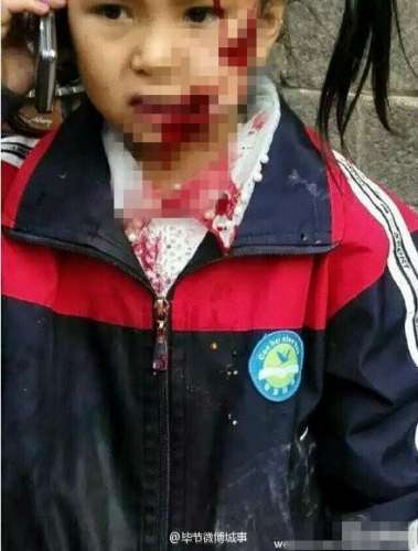 贵州8岁女童惨遭疯狗咬烂半边脸