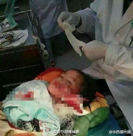 贵州8岁女童惨遭疯狗咬烂半边脸