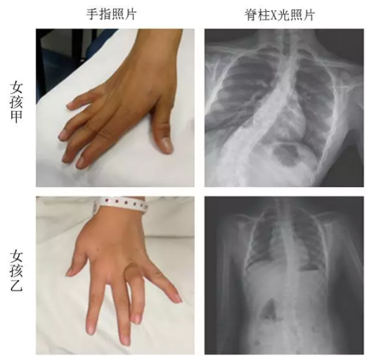两位罕见基因突变病患者的手指和脊柱都产生了严重的畸形，医学专家推测病因为身体缺少了“第六感”  图片来源：A.T. Chesler, et al, The New England Journal of Medicine, 2016.