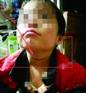 男童遭父亲家暴勒脖险丧命 老师称孩子已有阴影