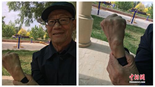 张永进向记者展示手上的伤疤。 点击进入下一页