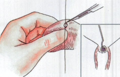 遭当地计划生育小组强行做结扎手术