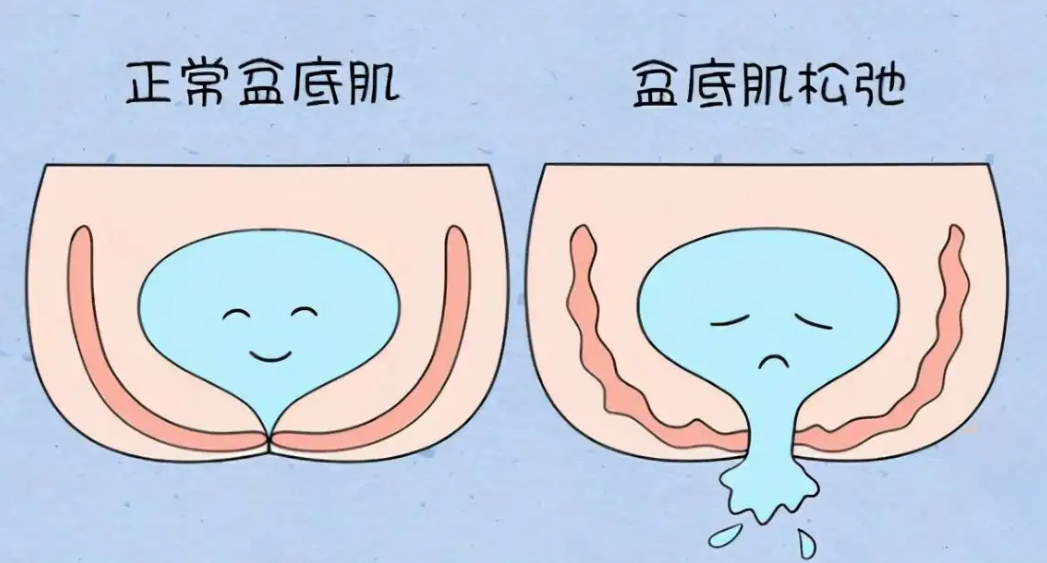 如何解决漏尿危机捷护佳安心吸水巾拯救尴尬